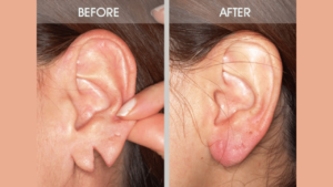 Ear-Lobe-Repair_in_Nalgonda