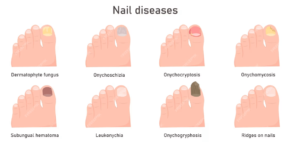 Nail-Diseases-Treatment-in-Nalgonda