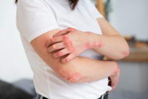 Psoriasis_Treatment_in_Nalgonda